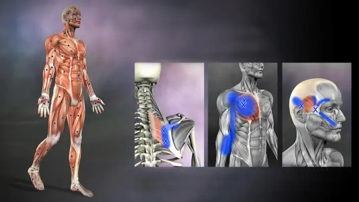 Muscle trigger point anatomie feature graphic