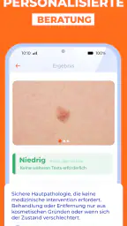 Haut Scanner: KI hautarzt app screenshot